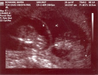 Baby Ultrasounds